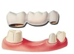 a dental bridge