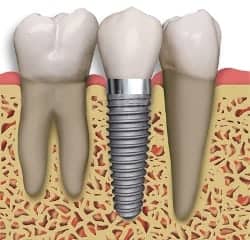 a single dental implant