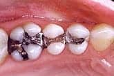 amalgam fillings