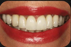 Gorgeous smile created by Dr. Newkirk