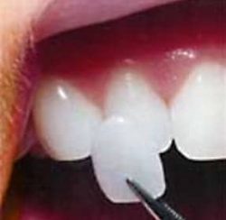 A single porcelain veneer being placed on a tooth