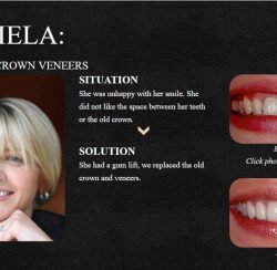 A Smile Makeover Done by Dr. Newkirk with Porcelain Veneers