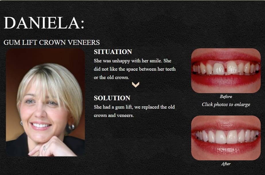 A Smile Makeover Done by Dr. Newkirk with Porcelain Veneers