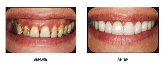 Before and after images of a smile makeover done by Dr. David Newkirk