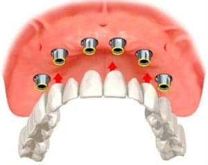 illustration of an implant overdenture