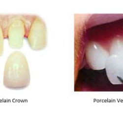 Left: porcelain crown; Right: porcelain veneer