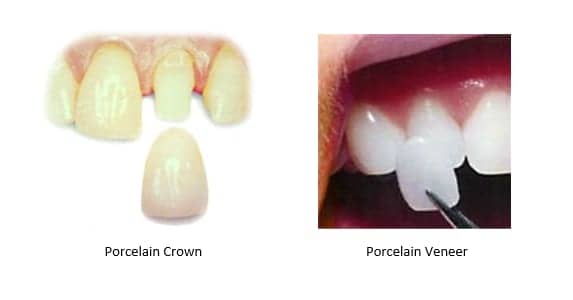 Left: porcelain crown; Right: porcelain veneer