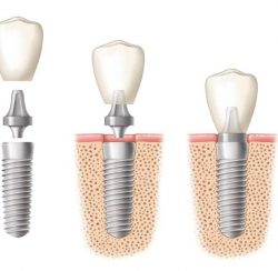 Ilustration of a dental implant crown being placed in three stages