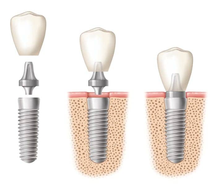 Ilustration of a dental implant crown being placed in three stages