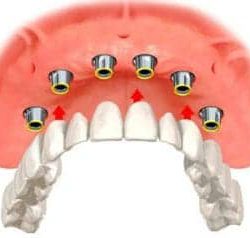 Implant Overdentures