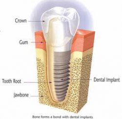 dental implant illustration