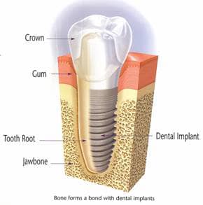 dental implant illustration