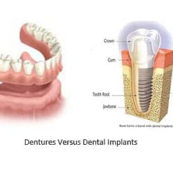 and image of dentures side by side to a dental implant