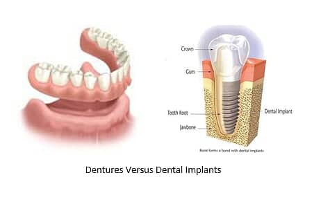 and image of dentures side by side to a dental implant