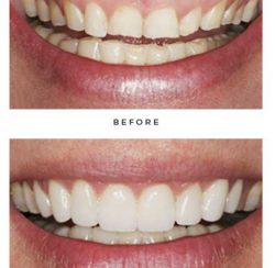 Before-and-after non-Lumineers photos of a patient's smile; from the Naperville dental office of Dr. David Newkirk.