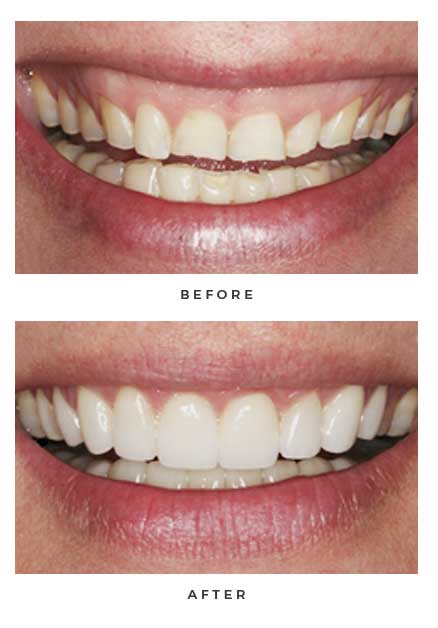 Before-and-after non-Lumineers photos of a patient's smile; from the Naperville dental office of Dr. David Newkirk.