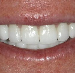 Beautiful smile done with porcelain veneers