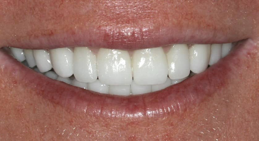 Beautiful smile done with porcelain veneers