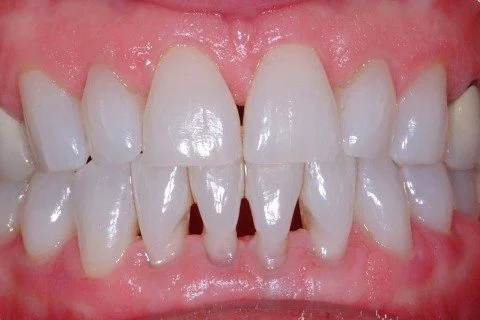 upper and lower teeth showing some black traingles