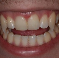 Vampire teeth done with dental bonding