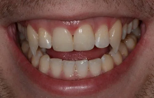 Vampire teeth done with dental bonding