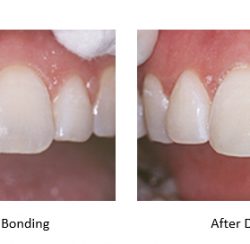 before and after dental bonding on a chipped tooth