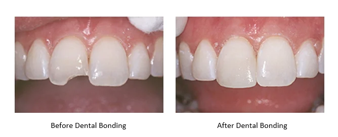 Can Dental Bonding Be Whitened?