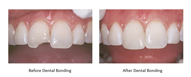 before and after dental bonding on a chipped tooth