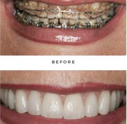 before and after case by Dr. Newkirk