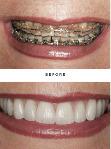 before and after case by Dr. Newkirk