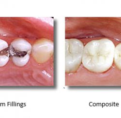 before and after mercury-free fillings