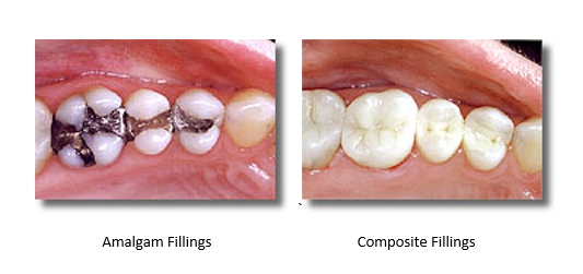 before and after mercury-free fillings