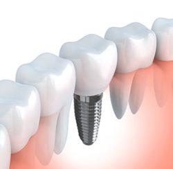 dental implant next to natrual teeth