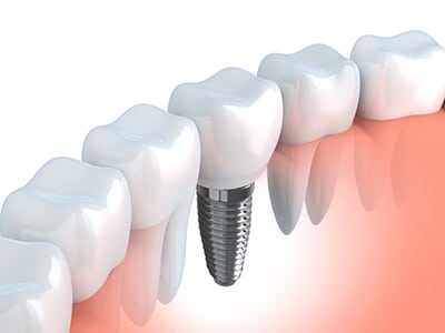 dental implant next to natrual teeth