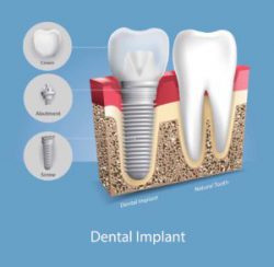 An illustration of a dental implant next to a natural tooth.