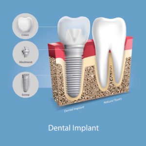 An illustration of a dental implant next to a natural tooth.