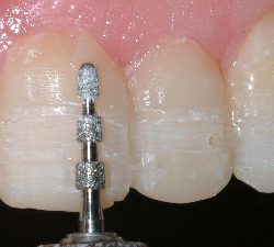 Teeth being prepped for porcelain veneers