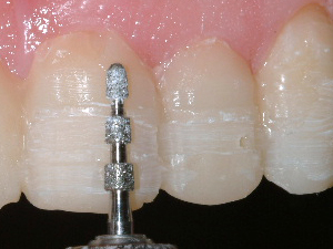 Teeth being prepped for porcelain veneers