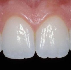 Image of natural looking teeth with dental work