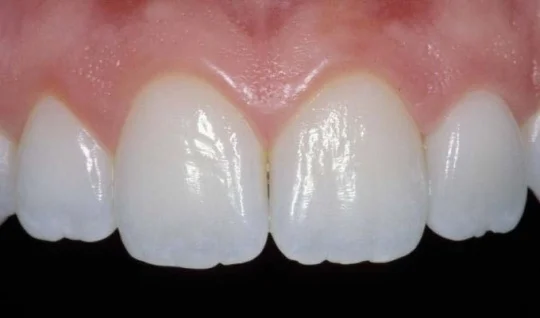 Image of natural looking teeth with dental work